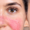 What Causes Red Skin (and How to Fix It with Handcrafted Skin Care)